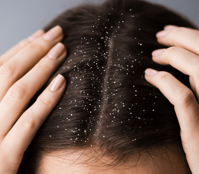 Scalp Problems