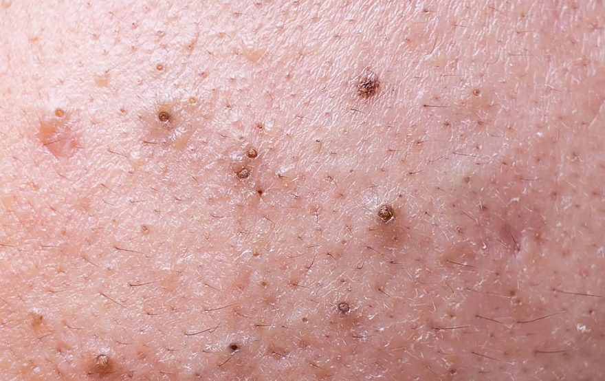 03-blackheads-whiteheads