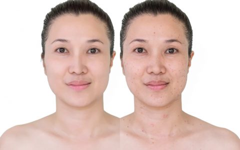 pigmentation treatment