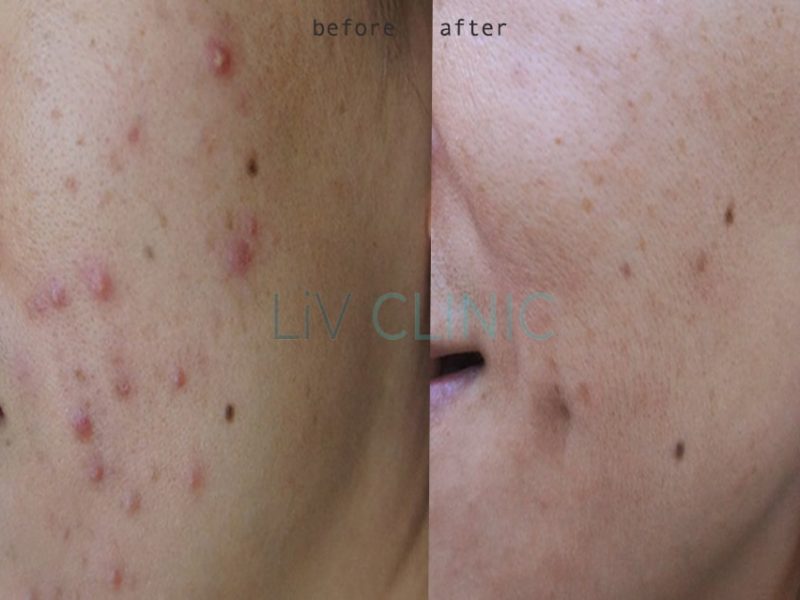 acne before after2