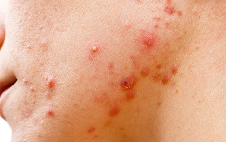 nodules