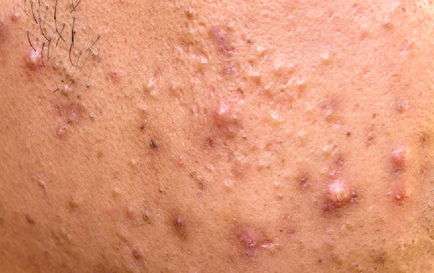 papules.png
