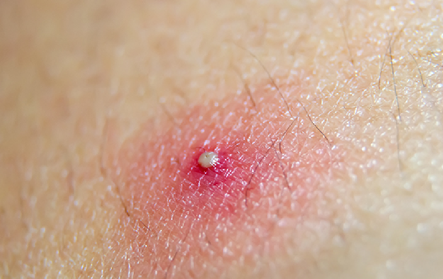 pustules