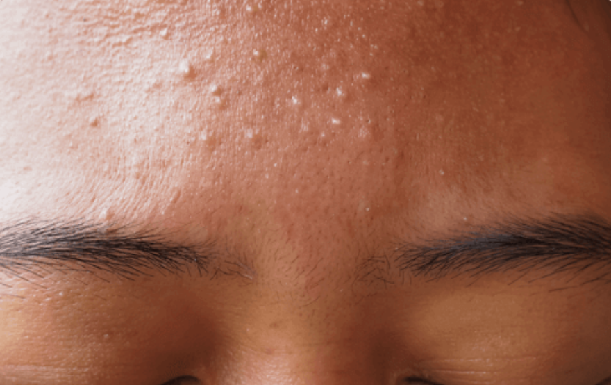 whitehead-acne